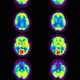 The brain with Alzheimer’s. Image: Université d’Angers